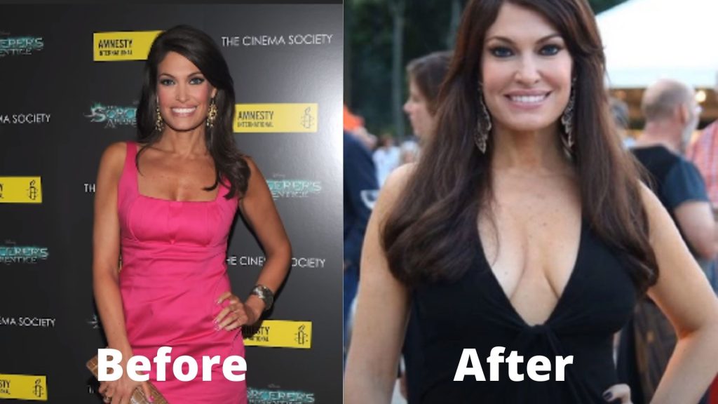 Kimberly Guilfoyle Plastic Surgery