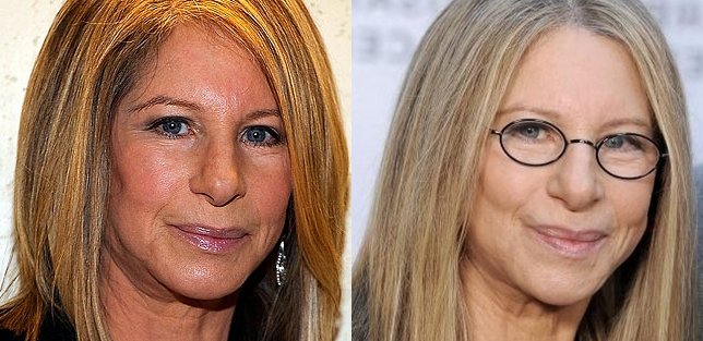 Barbra Streisand Plastic Surgery