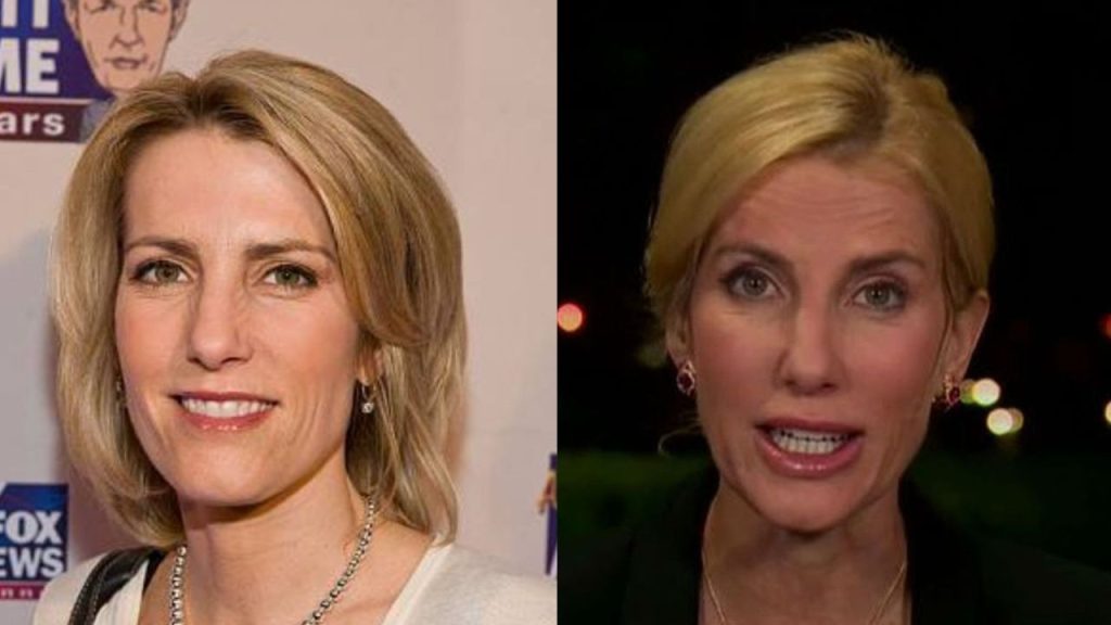 Laura Ingraham Plastic Surgery