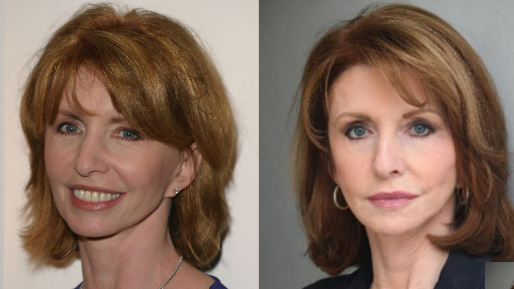 Jane Asher’s Plastic Surgery!