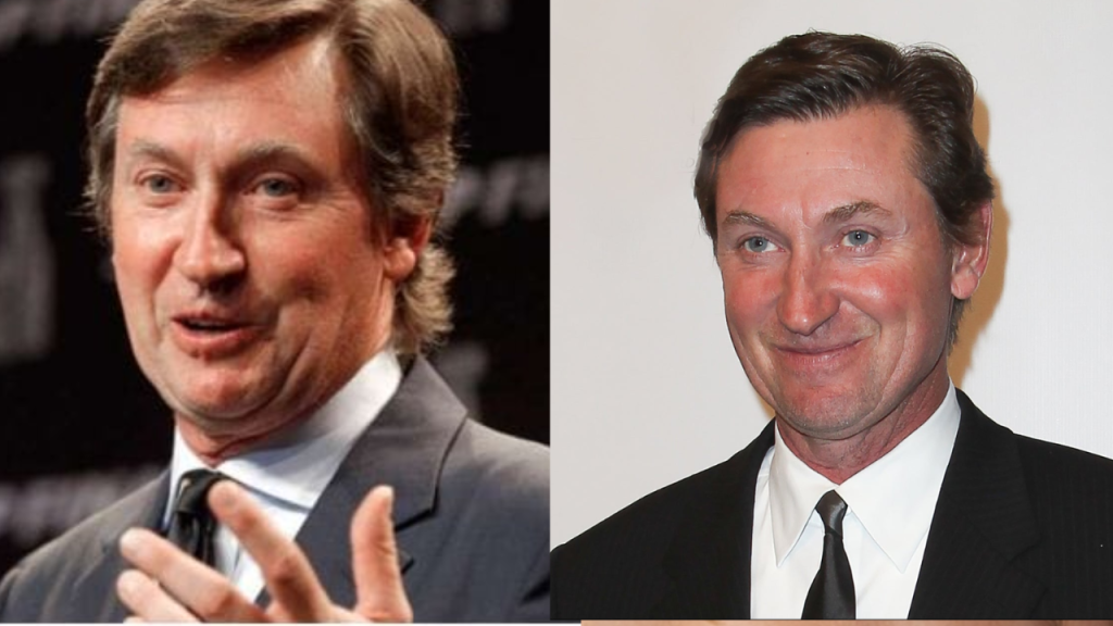 wayne gretzky plastic surgery