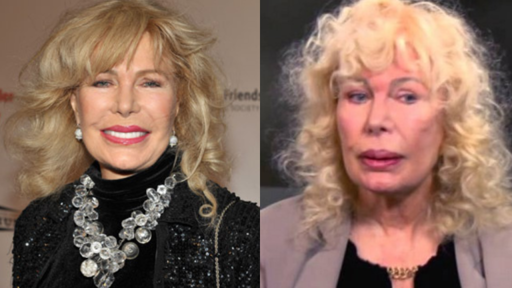 loretta swit plastic surgery