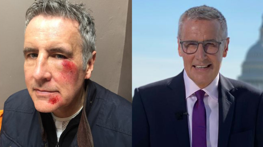 Dermot Murnaghan plastic surgery
