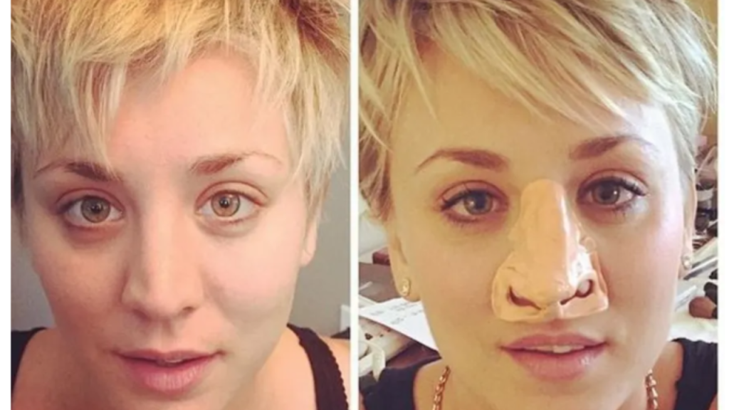 kaley cuoco plastic surgery