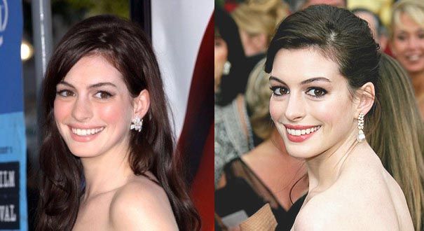 Anne Hathaway Plastic Surgery: Did Anne Hathaway Get Plastic Surgery?