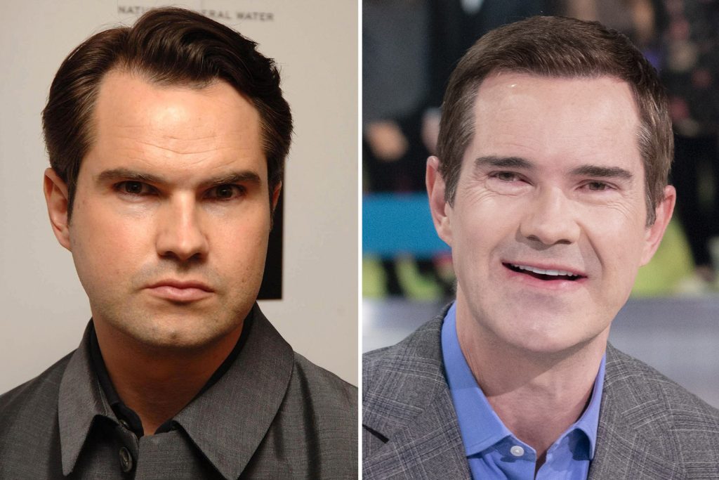 Jimmy Carr Gets Botox Treatment