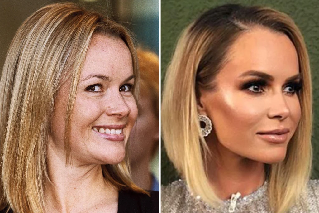 Amanda Holden Plastic Surgery