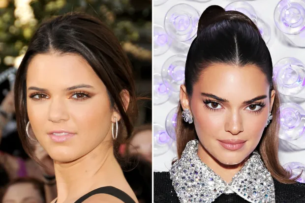 Kendall Jenner Plastic Surgery: Does She Really Get Plastic Surgery?