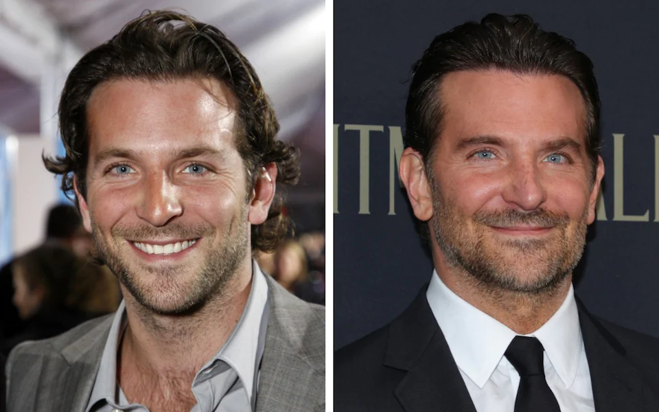 Bradley Cooper Plastic Surgery: Did He Have Any Plastic Surgery?