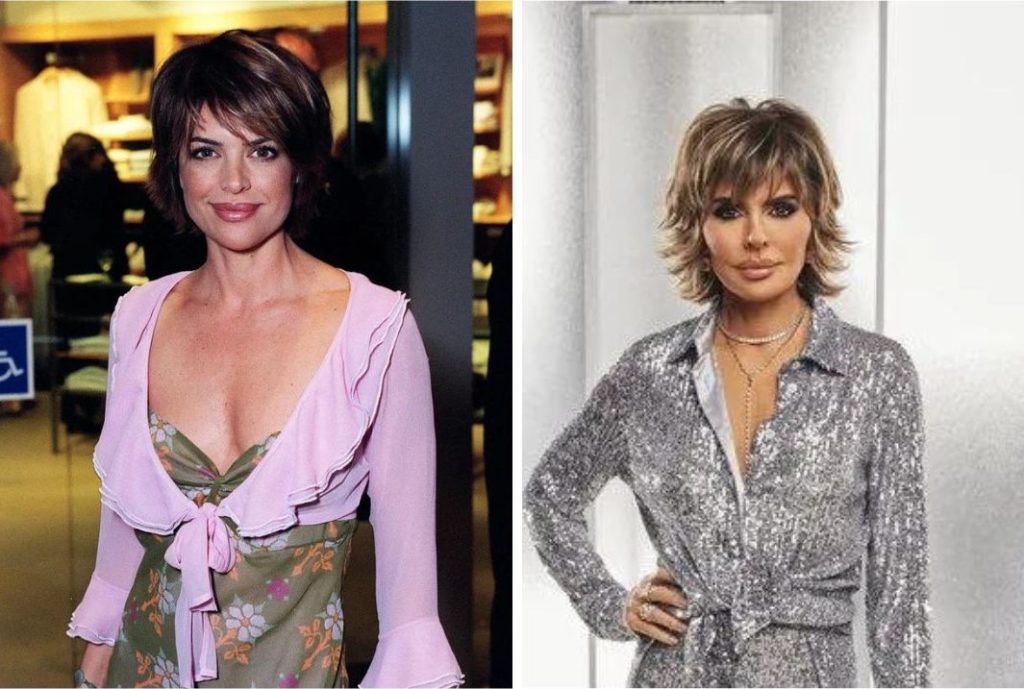 Lisa Rinna Plastic Surgery: What Problems Did She Face with Her Plastic Surgery?