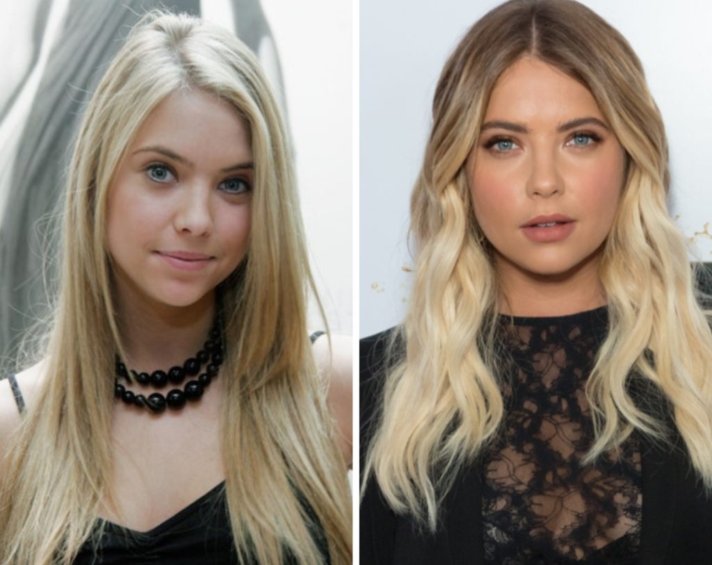 Ashley Benson Plastic Surgery: Did She Go Under the Knife? 