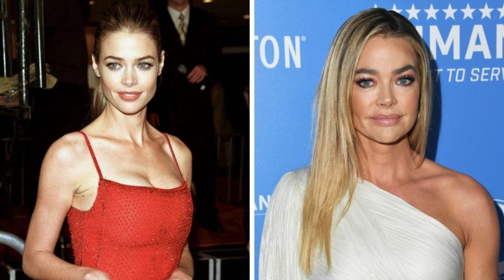 Denise Richards Plastic Surgery: Is She Has Done Any Plastic Surgery Treatment?